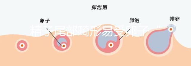 精子尾部畸形易受卵子“嫌棄”，無尾、短卷尾需重視