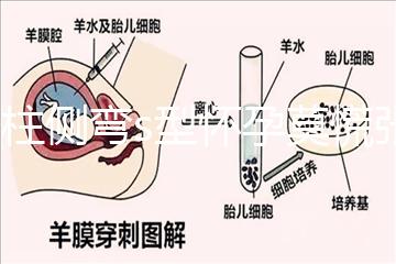 脊柱側彎s型懷孕莫慌張，能否順產還得看這4大要素