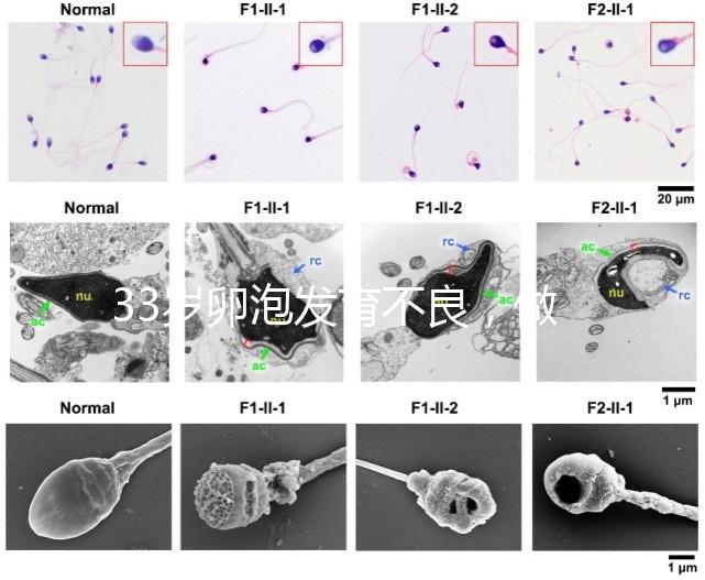 33歲卵泡發(fā)育不良,做試管黃體期促排方案失敗怎么辦?